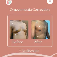 This before and after image shows a gynecomastia correction. For many men, this condition is caused by hormonal factors, not a lack of exercise. Our surgical procedure removes the glandular tissue and excess fat to create a flatter, more masculine chest contour.