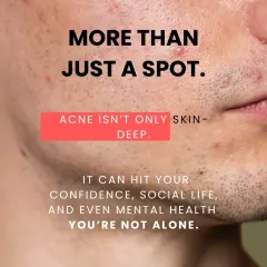 I understand that acne is more than skin deep. It can significantly impact confidence and mental health, which is why I offer compassionate care and effective solutions. You are not alone in this journey.
