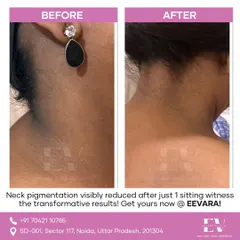 Dark pigmentation on the neck is a common concern, and I address it with targeted treatments. This before and after image shows a visible reduction in neck pigmentation after just one session, helping you feel confident in any wedding outfit.