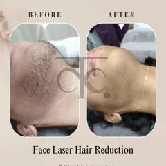 See the clear difference for yourself. This before and after shows the significant reduction in facial hair, leading to smoother skin and renewed confidence for our client.