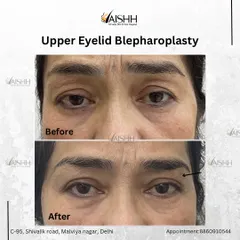 A close-up before-and-after of an upper eyelid blepharoplasty. This minor surgery removes excess skin from the upper eyelid, resulting in a brighter, more alert appearance.