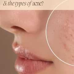 Understanding acne is the first step to treating it. This infographic provides a close-up look at how pores get clogged, leading to different types of acne.