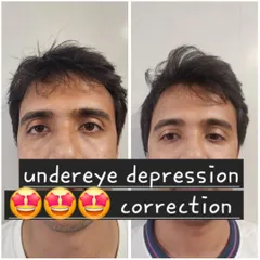 Anti-aging treatments are for everyone. This before and after demonstrates the correction of under-eye depression in a male client using fillers, effectively reducing the tired look and creating a smoother, more energized appearance.