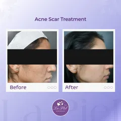 Acne scars can affect skin texture long after the breakouts have cleared. This result highlights the significant improvement in skin smoothness and tone after a specialized acne scar treatment, demonstrating how we help rebuild collagen and refine the skin's surface.