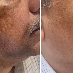 Addressing stubborn pigmentation requires a strategic approach. This result was achieved for a male patient using a combination of targeted in-clinic treatments and a dedicated skincare regimen designed to manage and reduce hyperpigmentation.