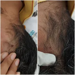 This before-and-after shot shows a successful wart removal from the patient's hairline. Our goal is always a cosmetically pleasing result with no trace of the previous blemish.