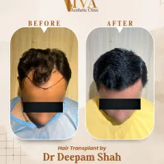 This is a classic example of restoring a receding hairline for a patient with Grade 3 hair loss. With 2500 grafts, we brought the hairline forward and added density, achieving this natural look in just 9 months.