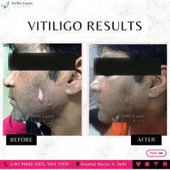 Here you can see the results of vitiligo treatment on the face. My goal is to help manage the condition and stimulate the return of natural skin color using a medically sound approach.