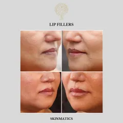 Lip enhancement is about achieving balance and proportion, not just size. Here, we used lip fillers to add subtle volume and definition, resulting in a naturally fuller and more hydrated look.
