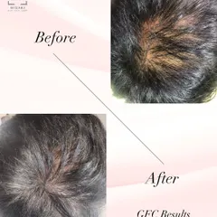 This client saw a remarkable difference after just one session of GFC. The 'after' photo shows not just more hair, but healthier and thicker strands covering the scalp more effectively.