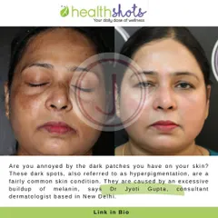 Healthshots featured my advice on managing hyperpigmentation, especially during the winter months. This before and after of one of my patients illustrates the successful treatment of dark spots, a common issue I address.