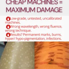 Using low-grade, uncalibrated machines with the wrong settings can cause maximum damage. The results are not just poor hair removal but permanent marks, burns, hyperpigmentation, and even infections, as seen in these real-world examples.