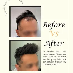 This before and after image, complete with our client's feedback, shows how we not only bring back hair but also restore self-assurance.