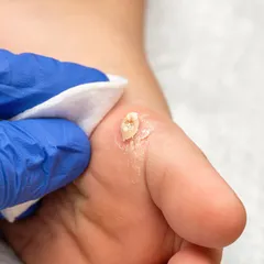 This image shows a common wart on the foot, which can be painful and stubborn. I use effective treatments like cryotherapy or RF cautery to completely remove the wart and destroy the underlying virus, preventing it from spreading or recurring.