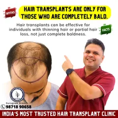 Myth: Transplants are only for the completely bald. Fact: Not at all. Transplants are very effective for people with thinning hair or partial hair loss to add density and redefine the hairline. Early action often gives the best results.