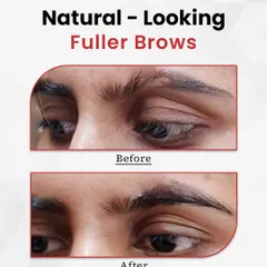 This before and after image shows the result of an eyebrow transplant. The procedure creates thicker, fuller, and natural looking brows, permanently enhancing facial features.