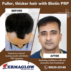 This before-and-after image demonstrates the effectiveness of our non-surgical Biotin PRP therapy. The treatment successfully addressed the client's receding hairline and thinning on top, resulting in visibly fuller and thicker hair.