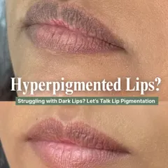 Dark or pigmented lips can be a common concern, and this before and after demonstrates a real transformation. Using a specialized Carbon Laser Peel for lips, I can safely lighten pigmentation and restore the natural, even tone of your lips over a few sessions.