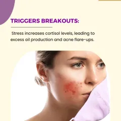 Stress increases the body's production of cortisol, a hormone that signals your glands to produce more oil. This excess oil can lead to clogged pores and frequent acne flare-ups, especially if you are already acne-prone.