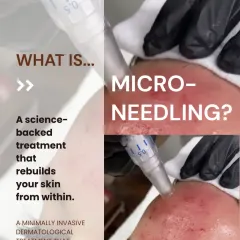 What is microneedling? It's a science-backed, minimally invasive dermatological treatment that rebuilds your skin from within. By stimulating controlled skin regeneration, it effectively improves texture, tone, and firmness.