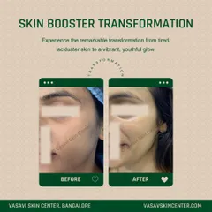 This before and after image shows the transformative effect of a Skin Booster treatment. You can see a significant improvement in skin radiance and texture, moving from a tired appearance to a vibrant, hydrated glow.