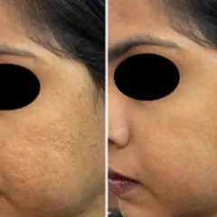 Here is another example of successful acne scar revision. My approach focuses on stimulating the skin's natural healing process to fill in pitted scars and create a more uniform, radiant complexion.