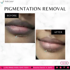 Darkening of the lips can be effectively treated with laser pigmentation removal. This before-and-after shows how the Q-Switch laser lightens the lips, restoring a more natural and even color.