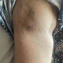 Here is another view of the affected leg prior to our intervention. Our goal is to create a personalized plan to address both the visible veins and the underlying circulatory issues.