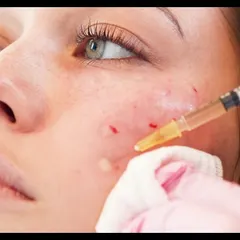 This close-up shows the PRP being applied during a Vampire Facial. This treatment is excellent for improving skin tone, reducing the appearance of acne scars, and giving your skin a natural, healthy radiance.