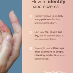 Hand eczema typically appears as red, scaly patches that can itch, burn, or even crack. Understanding how to identify these signs helps in seeking timely and appropriate dermatological care.