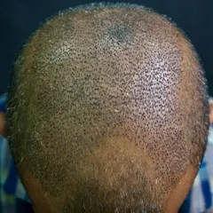 This is the result six months after a 3500-graft FUE transplant. The hair has grown in, covering the previously bald area and creating a full, natural look.