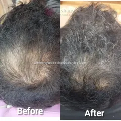 Seeing is believing. This is a typical result from my non-surgical hair growth treatments, showing significant improvement in hair density and scalp coverage after a few sessions.