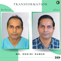 Meet Mr. Rohini Kumar. This side-by-side comparison highlights the dramatic difference a hair transplant can make, restoring fullness across the scalp and creating a more youthful frame for his face.