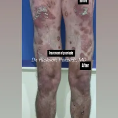 This before-and-after demonstrates the successful treatment of severe psoriasis on the legs. Biologic treatments target the root immune cause, offering significant clearance and improving overall health by reducing systemic inflammation.