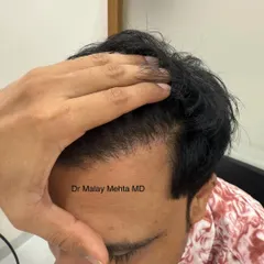 This patient's new hairline has been designed to suit his facial structure and age. The density is appropriate, and the angle of the transplanted hairs follows the natural direction of his original hair growth.