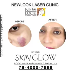 This before and after image showcases the significant reduction of a facial birthmark after treatment at our clinic. Our goal is to help you achieve clearer skin and renewed confidence with personalized dermatology solutions.