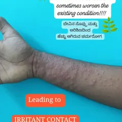 Please avoid self-treatment with home remedies like neem or turmeric on diseased skin. As this image shows, it can sometimes worsen the condition and lead to irritant contact dermatitis.