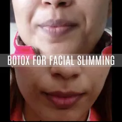 Here is another example of how Botox can refine the face shape. By relaxing the overactive jaw muscles, we achieved a softer and slimmer lower face, moving from a square shape to a more oval one.