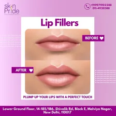 A clear before and after of a lip filler treatment. You can see the enhanced volume and improved symmetry, creating a perfect, plump pout.