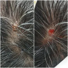 Here is a close-up before-and-after view of a viral wart removal from the scalp. Notice how the raised, textured wart is completely gone, leaving a clean surface that will heal without scarring. This is a common treatment we perform with high success.