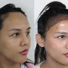 This side view shows how the new hairline will frame her face more effectively once the hair grows in.