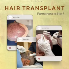 So, is a hair transplant permanent? This series of posts explains what to expect in the long term.