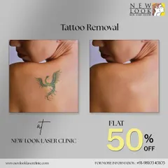 This before and after image shows the significant fading of a green ink phoenix tattoo. Our process is effective on a wide range of ink colors, helping you achieve clear, rejuvenated skin.