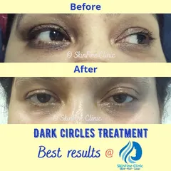 Here you can see the visible improvement in under eye dark circles. This result was achieved through a combination of gentle, targeted chemical peels and specialized creams designed to reduce periorbital pigmentation and improve blood circulation in the delicate eye area.