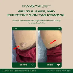 Here you can see a clear before-and-after of a skin tag removal from the underarm area. The procedure is quick, minimally invasive, and the final result is smooth, clear skin with no trace of the previous growth.