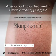 Strawberry legs are a common concern we effectively treat. By using Alma Soprano laser technology, we target hair at the root, preventing the clogged pores and ingrowns that cause the dotted appearance.