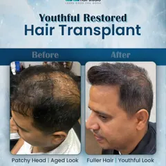 A hair transplant can do more than just restore hair; it can restore a youthful appearance. This client went from a patchy, aged look to fuller hair that completely refreshed his style.