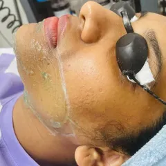 Here is a look at a facial hair removal session in progress. I take great care, especially on sensitive areas, using a cooling gel and protective eyewear to ensure the treatment is both safe and effective for achieving smooth skin.
