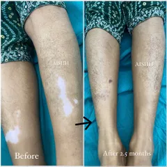 This patient saw a dramatic improvement in just 2.5 months. It is important to remember that vitiligo is a treatable, non-contagious condition, and no one should face social stigma because of it.