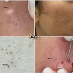 This case highlights the importance of a correct diagnosis. What appeared to be simple acne comedones was actually calcinosis cutis, a rare condition involving calcium deposits. After a skin biopsy, we successfully treated it with laser and excision.
